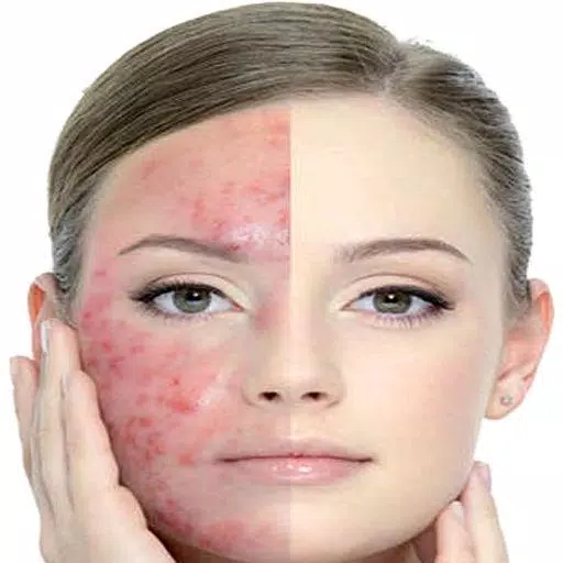 Get Rid of Acne  (Guide) capture d’écran 1